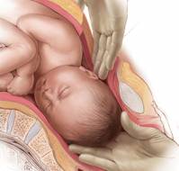 Comparative Efficacy of Vacuum-Assisted and Manual Extraction Cesarean Deliveries