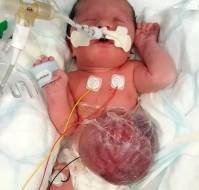 A Rare Case of Exomphalos Linked to Prenatal Alcohol Exposure