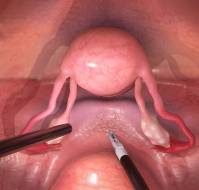 Association Between Previous Surgical Treatment and Outcomes of Repeat Endometriosis Surgery