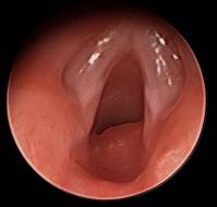 Pediatric Supraglottic Hemangioma Causing Airway Obstruction: A Case Report