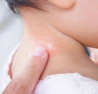 Determinants of the Atopic March in Children with Early-Onset Atopic Dermatitis