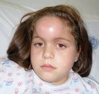 Post-Traumatic Potts Tumor with Frontal Empyema in a Child