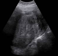 A Case of Renal Metastasis of Uterine Leiomyosarcoma