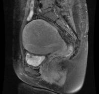 Efficacy of Myomectomy Post-HIFU in Treating Recurrent Uterine Fibroids