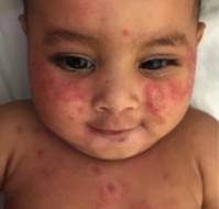 Atopic Dermatitis in Indian Children: Insights from a Nationwide Parental KAP Survey