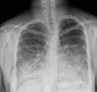 A Rare Case of Fulminant Mycoplasma pneumoniae Pneumonia With ARDS