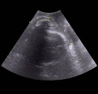 Intrapartum Sonography: Redefining Evaluation of Fetal Head Position