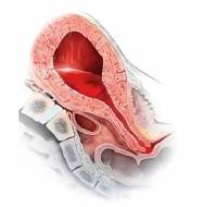A Successful Case of Postpartum Haemorrhage Managed with Internal Iliac Artery Ligation