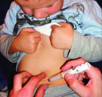 Transient Neonatal Diabetes: Successful Insulin Cessation with SAP Support