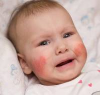 Managing Childhood and Adolescent Atopic Dermatitis in Primary Care