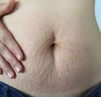 Pelvic Floor Dysfunction Two Decades After Childbirth: Urinary, Fecal Incontinence, and Prolapse