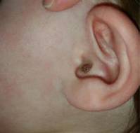 Atypical Right Atrial Mass in a Neonate: Myxoid Spindle Cell Tumor Case Report