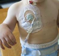 Mastering Ultrasound-Guided Percutaneous Central Venous Port Placement in Pediatric Surgery: Navigating the Learning Curve