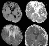 Neonatal Paenibacillusthiaminolyticus Infection: A Rare Case of Sepsis and Meningoencephalitis