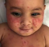 Survey Reveals Key Gaps in Parental Awareness of Atopic Dermatitis in Indian Children