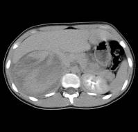 Incidental Findings on Abdominal CT in Pediatric Blunt Trauma: A Prevalence Study
