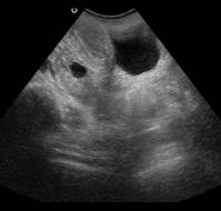 A Rare Case of Second-Trimester Ovarian Pregnancy Rupture With Neurologic Presentation