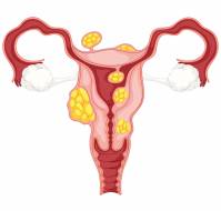 Clinical Outcomes of Myomectomy After High-Intensity Focused Ultrasound for Uterine Fibroids 