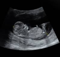 Complex Exomphalos in a Chromosomally Normal Fetus: A Case Report