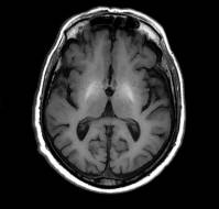 A Genetic Cause of Hyperammonemic Encephalopathy in an Infant