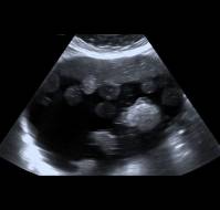 A Rare Presentation of Dual Ovarian Pathologies