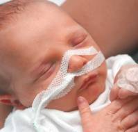 A premature baby with respiratory distress