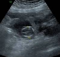 A rare and unusual case of bilateral tubal ectopic pregnancies