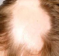 Alopecia Universalis Treatment in a Child with Down Syndrome