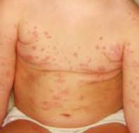 Alpha-gal syndrome misdiagnosed as chronic spontaneous urticaria in a pediatric patient.