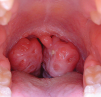 Factors influencing post-operative growth in pre-pubertal children after adenotonsillectomy