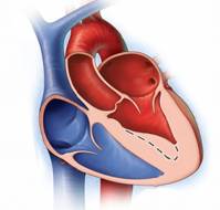 Atrial Septal Defect (ASD): Symptoms, Causes, Tests and Treatments ...