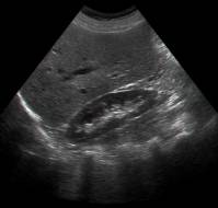 Choosing the Right Age Group for Ultrasonography Screening After Initial Childhood Urinary Tract Infection