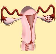Clomiphene citrate plus metformin Vs. Clomiphene citrate alone for induction of ovulation in women with polycystic ovarian syndrome.