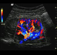 Color Doppler in high-risk pregnancies