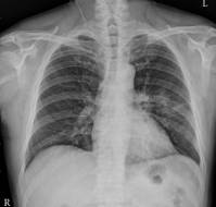 Complicated Acute Pericarditis Caused by Methicillin-Resistant Staphylococcus aureus after Influenza B Virus Infection: A Case Report
