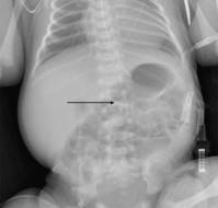 Congenital Duodenal Obstruction Presenting as an Olive-Shaped Abdominal Mass: Case Study