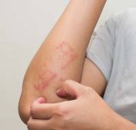 Contact Dermatitis to a Topical Antibiotic after Skin Injury