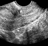 Definition and sonographic reporting system for Cesarean scar pregnancy in early gestation: modified Delphi method