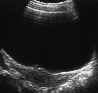 Diagnostic Accuracy of Female Pelvic Ultrasonography in Differentiating Precocious Puberty from Premature Thelarche: A Systematic Review and Meta-analysis