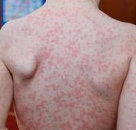 Disseminated life-threatening viral skin rash in a child with AD