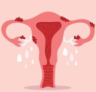 ESHRE guideline: endometriosis†