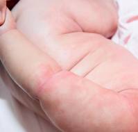 Effects of Topical Oils on Neonatal Skin