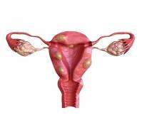 Embolization to Treat Uterine Fibroids with Bleeding and Severe Anemia