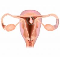 Endometrial Polyps and Postoperative Septic Shock in a Young Woman