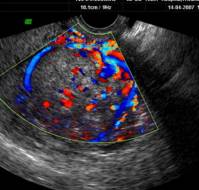 Endometrial Stromal Tumor Mimicking Fibroid Uterus 
