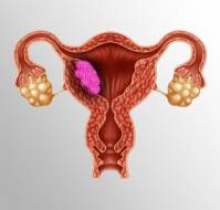 Endometrial carcinoma in a gravid uterus