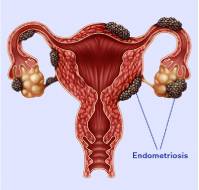 Endometriosis Pathogenesis: New Insights into Potential Therapies