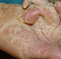 Epidermolytic Ichthyosis in a Neonate