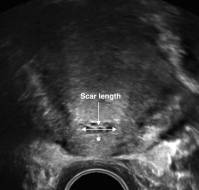 Evaluation of the Urinary Bladder Before Cesarean Delivery in Women with Multiple Abdominal Scars using Table Ultrasound Imaging
