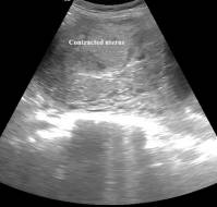 First-trimester uterine rupture: a case report